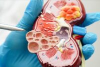 گرمای شدید و سرمای افراطی، دشمن پنهان کلیه‌ها