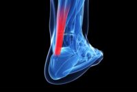 چگونه از آسیب‌های تاندون پیشگیری کنیم؟